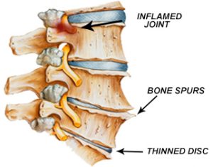 Degenerative disc disease